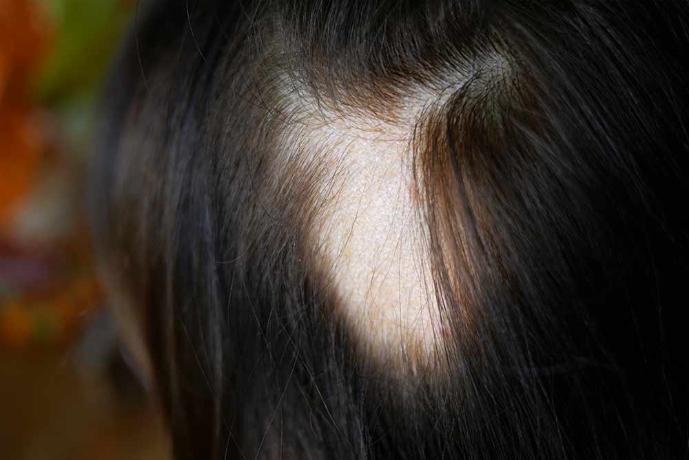 alopecia